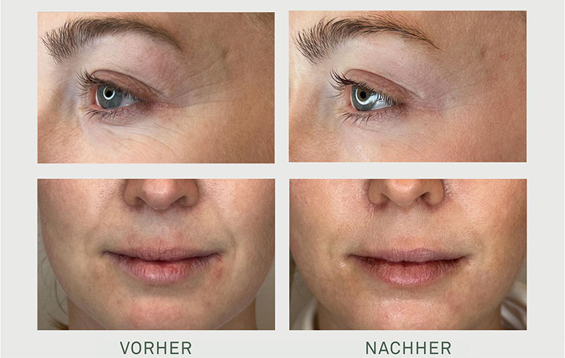 infuzion system vorher nachher